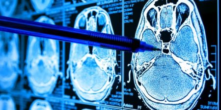 Polacy opracowali atlas mechanizmów rozwoju guzów mózgu